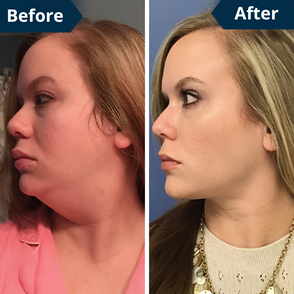 FaceLift™ – Anti-Wrinkle & Double Chin Sculpting Device + FREE Aloe Vera Gel