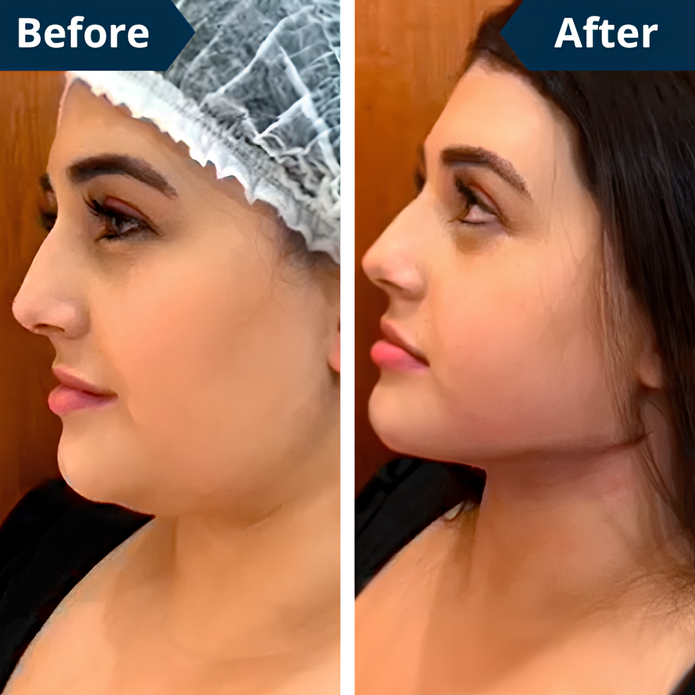 FaceLift™ – Anti-Wrinkle & Double Chin Sculpting Device + FREE Aloe Vera Gel