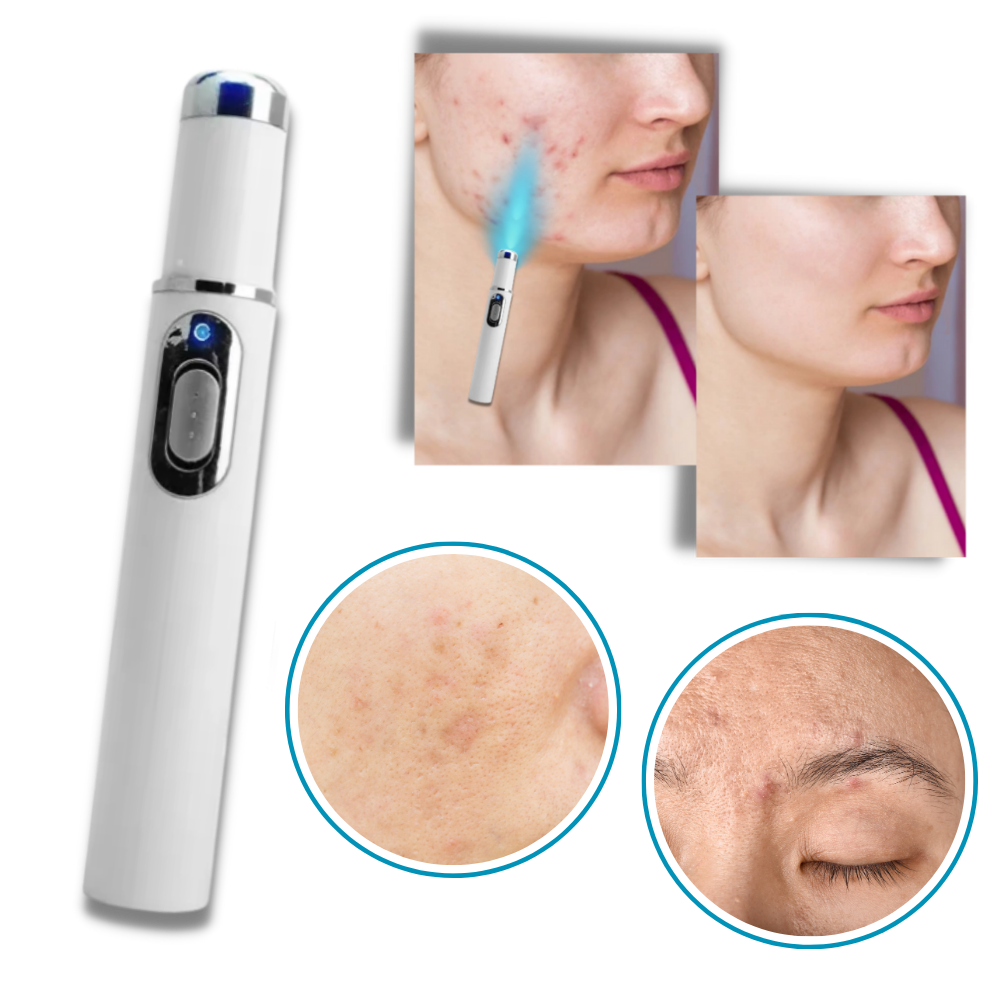 Dark Spot Remover Blue Laser Pen