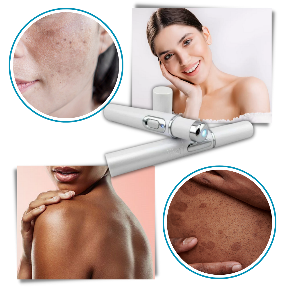 Dark Spot Remover Blue Laser Pen